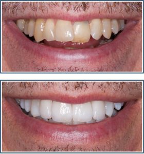 Porcelain Veneers and Bleaching