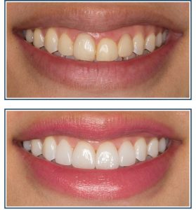 Gingival Recontouring, Porcelain Veneers and Bleaching