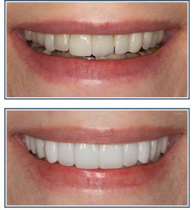 Porcelain Veneers and Crowns, Smile Makeover