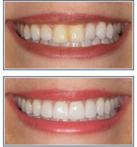 Invisalign, Porcelain Veneers and Bleaching