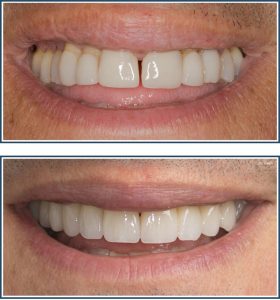 Porcelain Veneers and Crowns, Smile Makeover