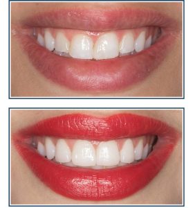 Gingival Recontouring and Porcelain Veneers