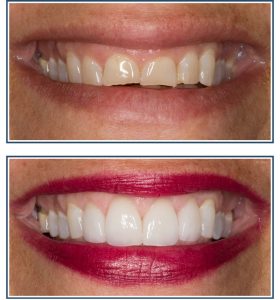 Gingival Recontouring, Porcelain Veneers and Bleaching