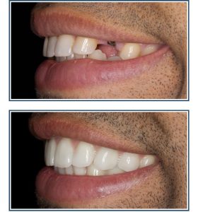 Dental Implant, Porcelain Crown and Veneers