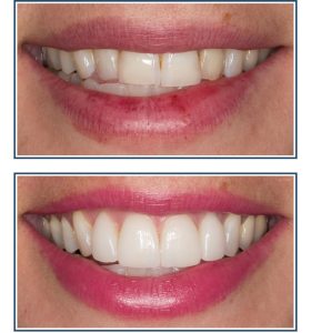 Porcelain Veneers