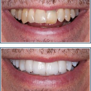 Porcelain Veneers and Bleaching
