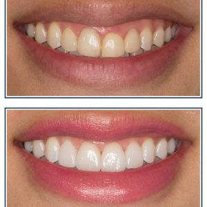 Gingival Recontouring, Porcelain Veneers and Bleaching