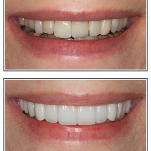 Porcelain Veneers and Crowns, Smile Makeover