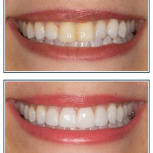 Invisalign, Porcelain Veneers and Bleaching