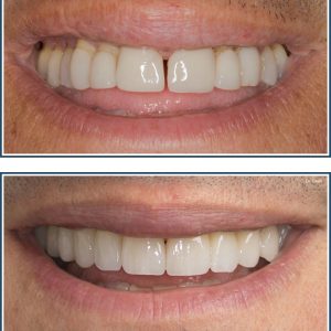 Porcelain Veneers and Crowns, Smile Makeover