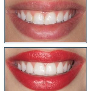 Gingival Recontouring and Porcelain Veneers