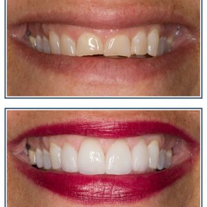 Gingival Recontouring, Porcelain Veneers and Bleaching