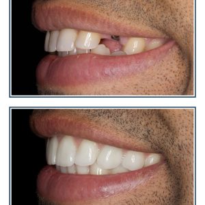 Dental Implant, Porcelain Crown and Veneers