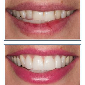 Porcelain Veneers